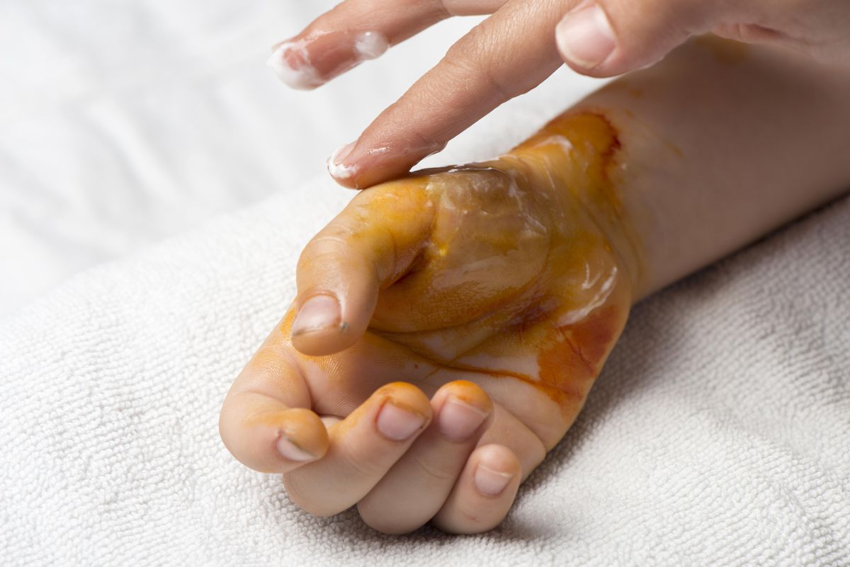 Burned Children’s Recovery&nbsp;Foundation